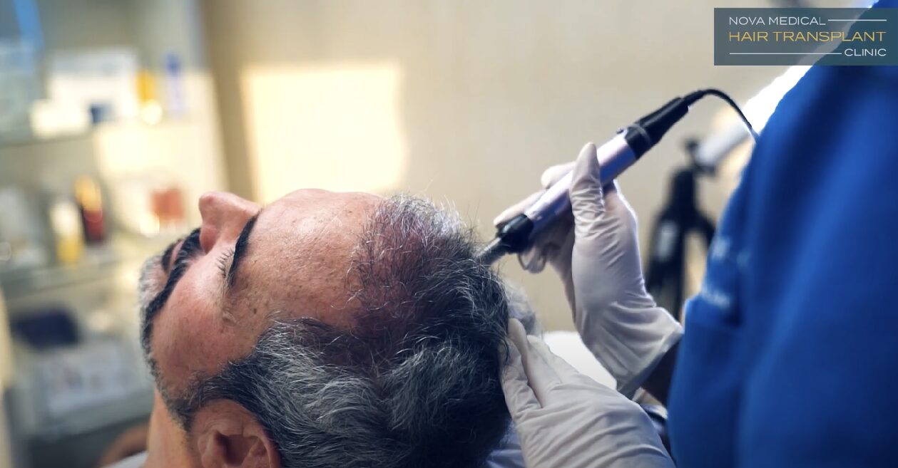 Hair restoration treatment in progress at Nova Medical Hair Transplant Miami