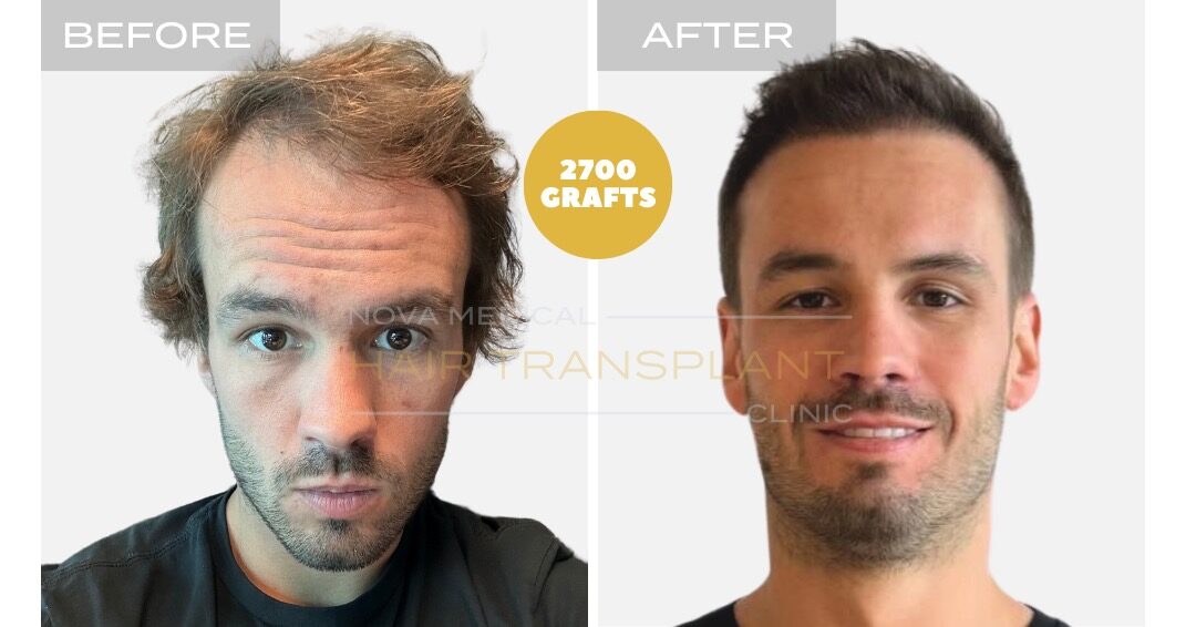 Hairline and density restoration, manual FUE 2700 grafts - Nova Medical Miami