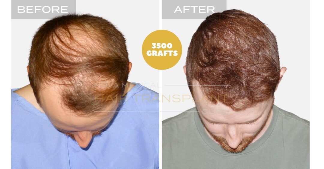 Hairline formation and crown density restoration, micro FUE 3500 grafts - Nova Medical Miami