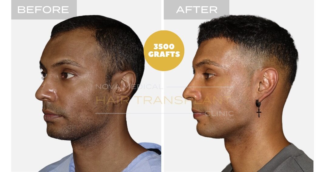 Thick hair hairline restoration, manual FUE 3500 grafts - Nova Medical Miami