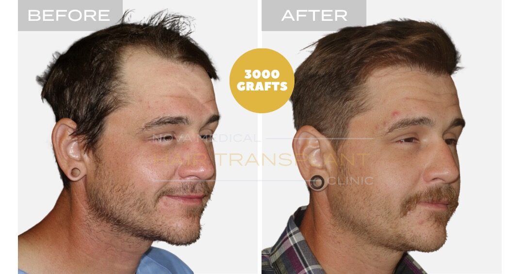 High density hairline restoration, manual FUE 3000 grafts - Nova Medical Miami