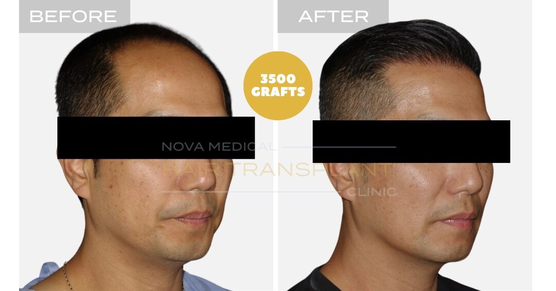 High density hairline restoration, Asian hair manual FUE 3500 grafts - Nova Medical Miami