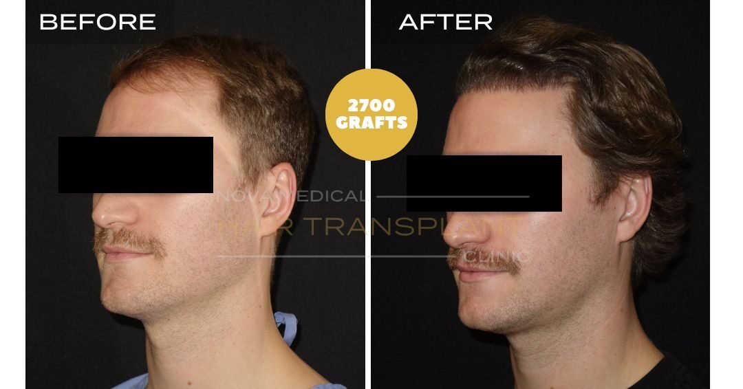 Hairline and density restoration, manual FUE 2700 grafts - Nova Medical Miami