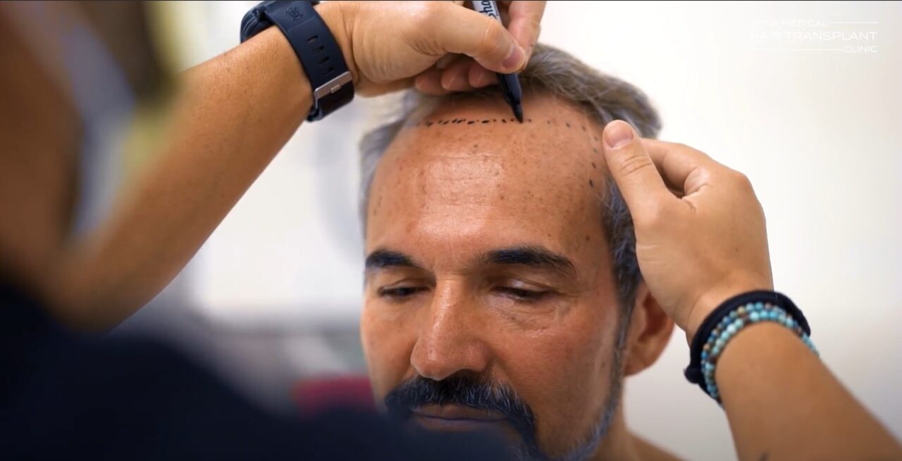 Hairline being marked before a hair transplant at Nova Medical Miami