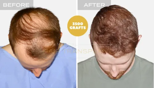 Hair transplant before and after result 2